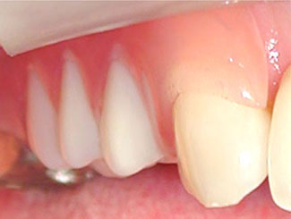 歯肉に近い透明感のある素材でつくるスマイルデンチャー