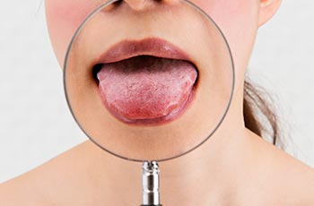 舌の痛みや痺れの改善『舌痛症』